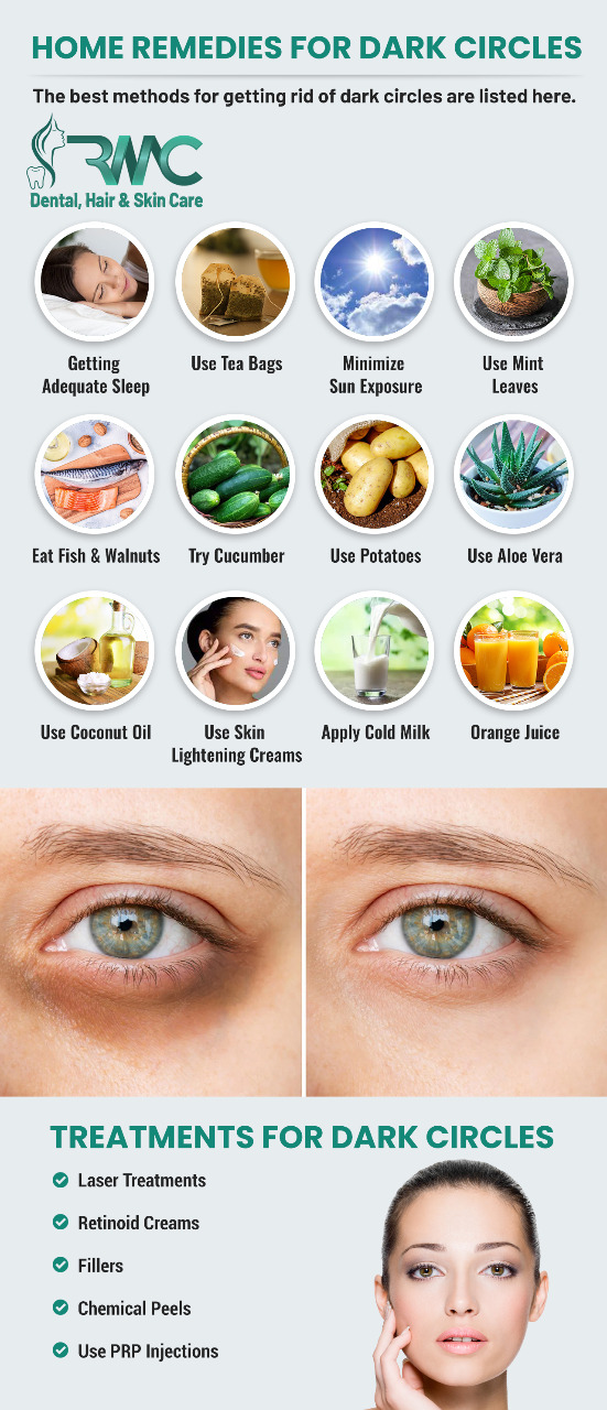 How To Remove Dark Circles Under Eyes Permanently Rmc