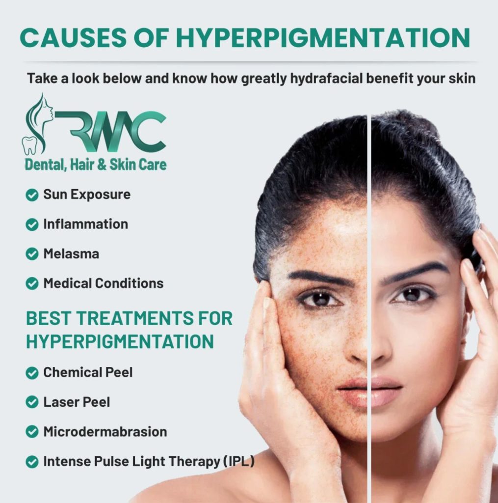 Hyperpigmentation Skincare Treatment in Islamabad | Rehman Medical Center