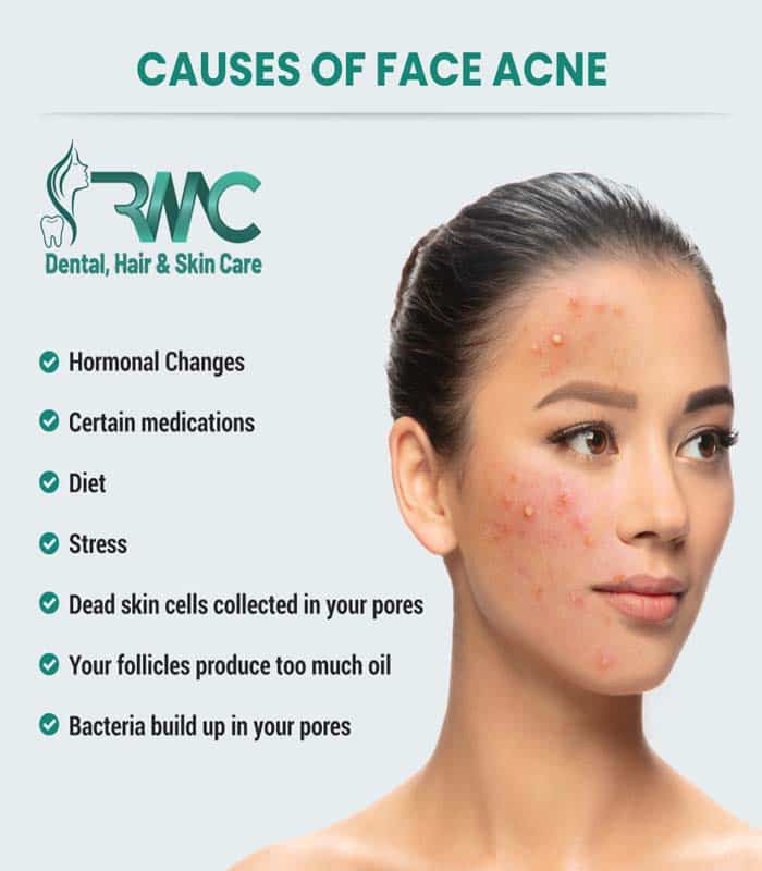 Causes of Face acne