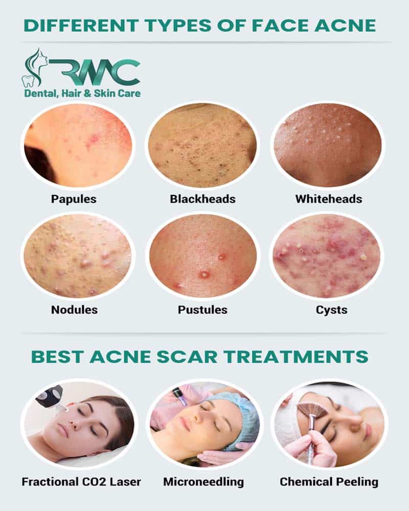 best acne scar treatment