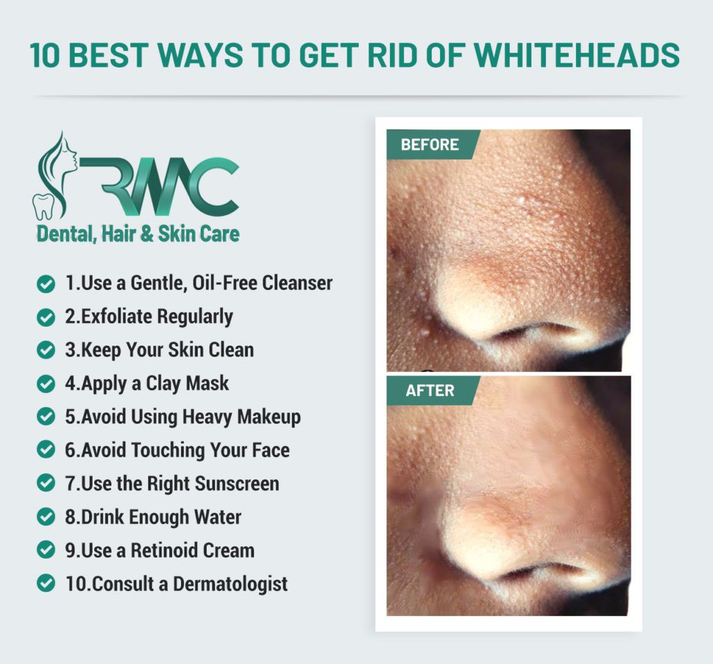 how-to-get-rid-of-whiteheads-on-face-programsrun